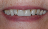 Réfection sourire, cas 3
