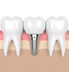 Implant dentaire et sa couronne entre deux dents naturelles, vue 3D