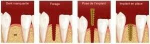 Pose d'implants et couronnes