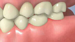 Bridge versus Implant