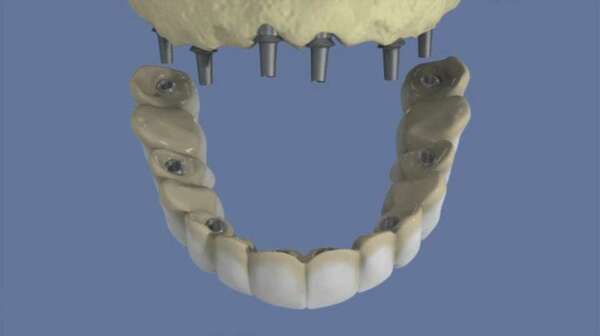 Maxillaire : bridge complet scellé sans fausse gencive