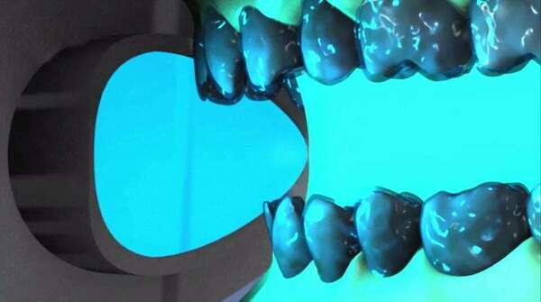 Blanchiment au fauteuil