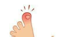 Ongle incarné : comment le prévenir et comment le soigner?