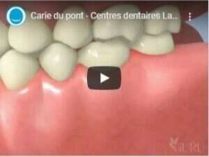 Carie du pont