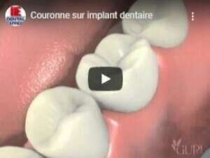 Couronne sur implant dentaire