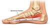 aponévrose plantaire