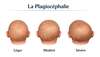 plagiocéphalie léger, modéré et sévère