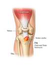 Osgood-schlatter schéma anatomique
