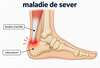 maladie de sever schéma