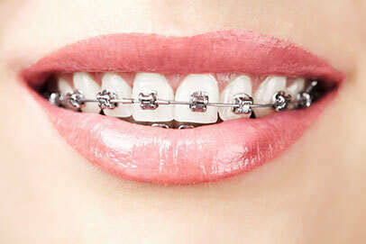 Collage des attaches (ou "bagues", ou brackets) en orthodontie