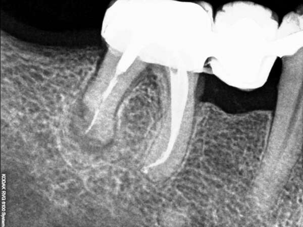 La chirurgie d'un kyste.