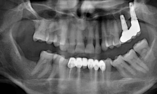 Cas d'une guérison parodontale. Réalisé à Auriol, proche Aubagne