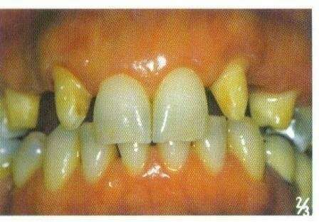 Les bridges : conseils à AURIOL