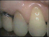 La couronne céramique CEREC : cas au cabinet d'Auriol