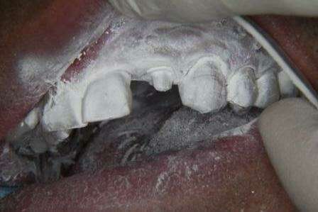 La couronne céramique en 3D cerec, réalisée à Auriol, Aix en Provence