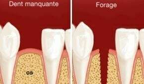 Pose d'implants à Auriol