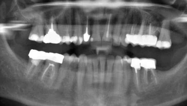 Extraction et pose simultanée d'un implant: cas réalisé à Auriol (Aix en Provence)