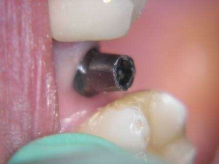 Implant suite à une forte perte osseuse