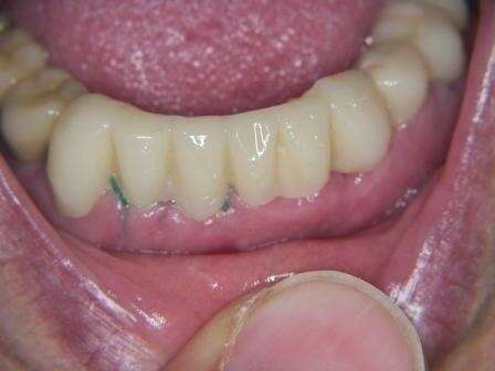 Implants et bridge immédiat