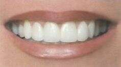 Les facettes LUMINEERS