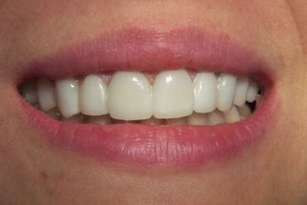 Facettes : galerie avant-après