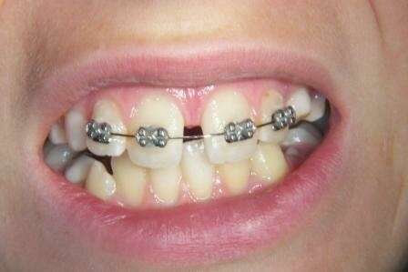Orthodontie et freins labiaux