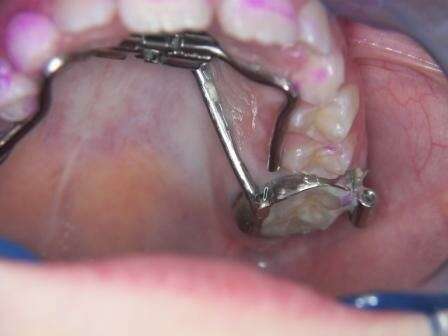 L'orthodontie et les caries.