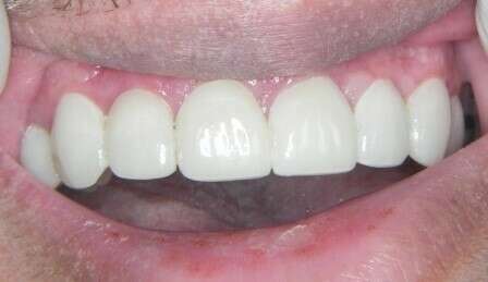 Cas de gouttière d'alignement associé aux facettes