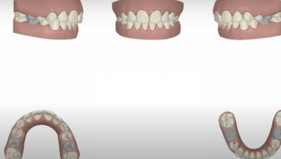 Simulation d'un traitement par gouttière pour un enfant