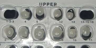 Orthodontie adulte et facettes (Marseille)