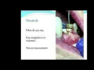 Parodontie avec laser Nd-Yap Lokki