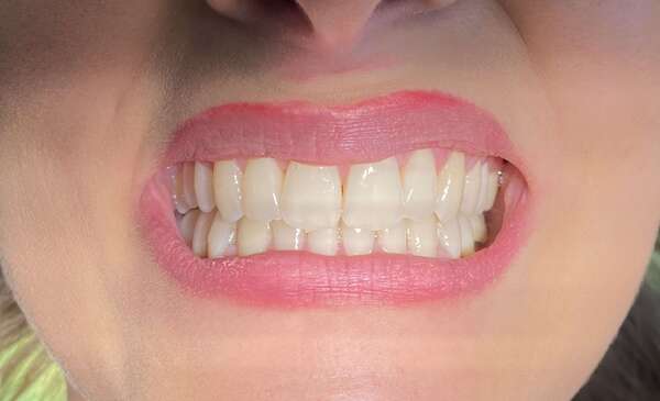 Orthodontie adulte par gouttière