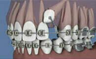 Orthodontie : la traction d'une canine palatine incluse