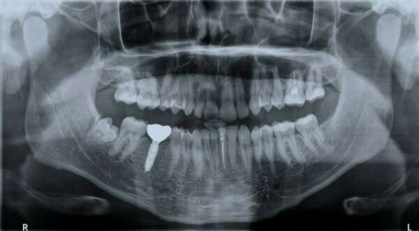 Le dossier orthodontique, à quoi servent les radios?