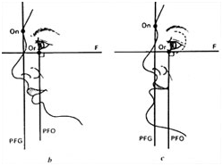 Dans quels cas a-t-on recours à la chirurgie orthognathique ?