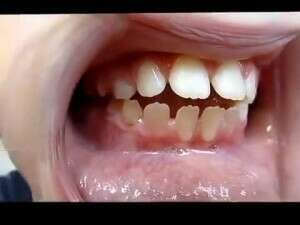 Tongue Thrust Video, Myofunctional Therapist