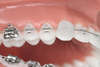 Bagues Cabinet d'Orthodontie des Drs BOURHIS et LAWNICZAK