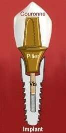 QU'EST CE QU'UN IMPLANT DENTAIRE? INDICATIONS ET CONTRE-INDICATIONS