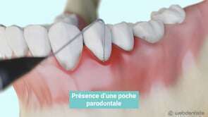 Le surfaçage