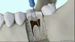 Traitement ultrasonique de la parodontite