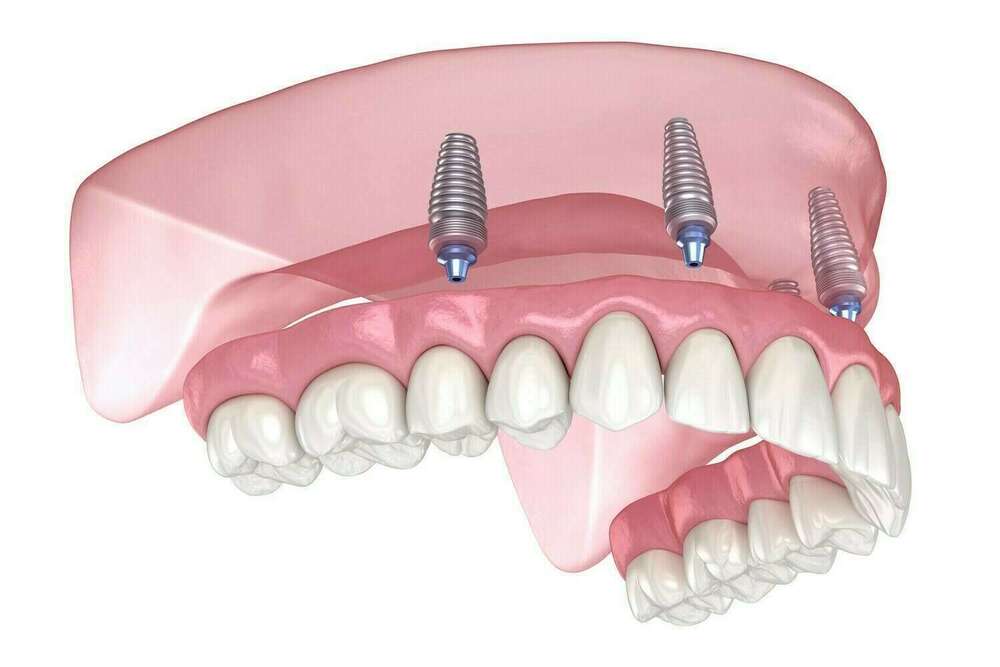 Stabilisation des prothèses amovibles complètes