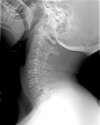 radiographie cervicales