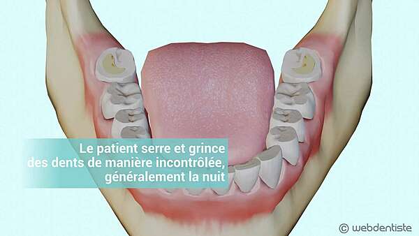 Bruxisme et usure dentaire