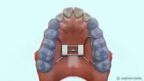 Expansion palatineactivation du disjoncteur
