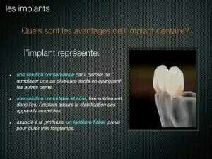 Qu'est-ce qu'un implant dentaire ?