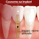 Qu'est-ce qu'un implant dentaire ? Indications et contre-indications