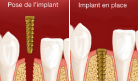 Pose d'implants