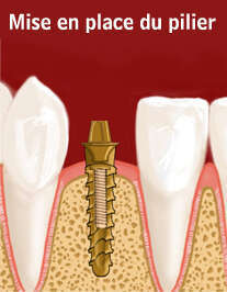 Prothèse sur implant
