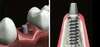 Les différentes pièces d’un implant