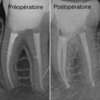 Retraitement préopératoire et postopératoire